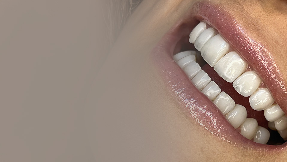 Facetas em resina estratificadas em Curitiba - sorriso natural