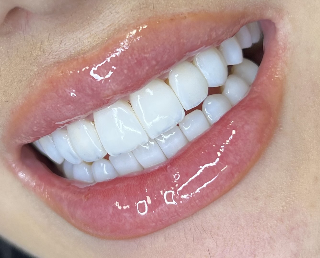 Reabilitação oral em Curitiba com sorriso natural