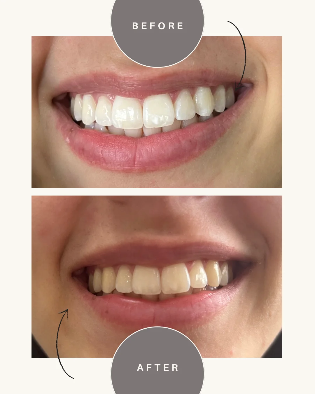 Resultado de clareamento dental com sorriso mais iluminado
