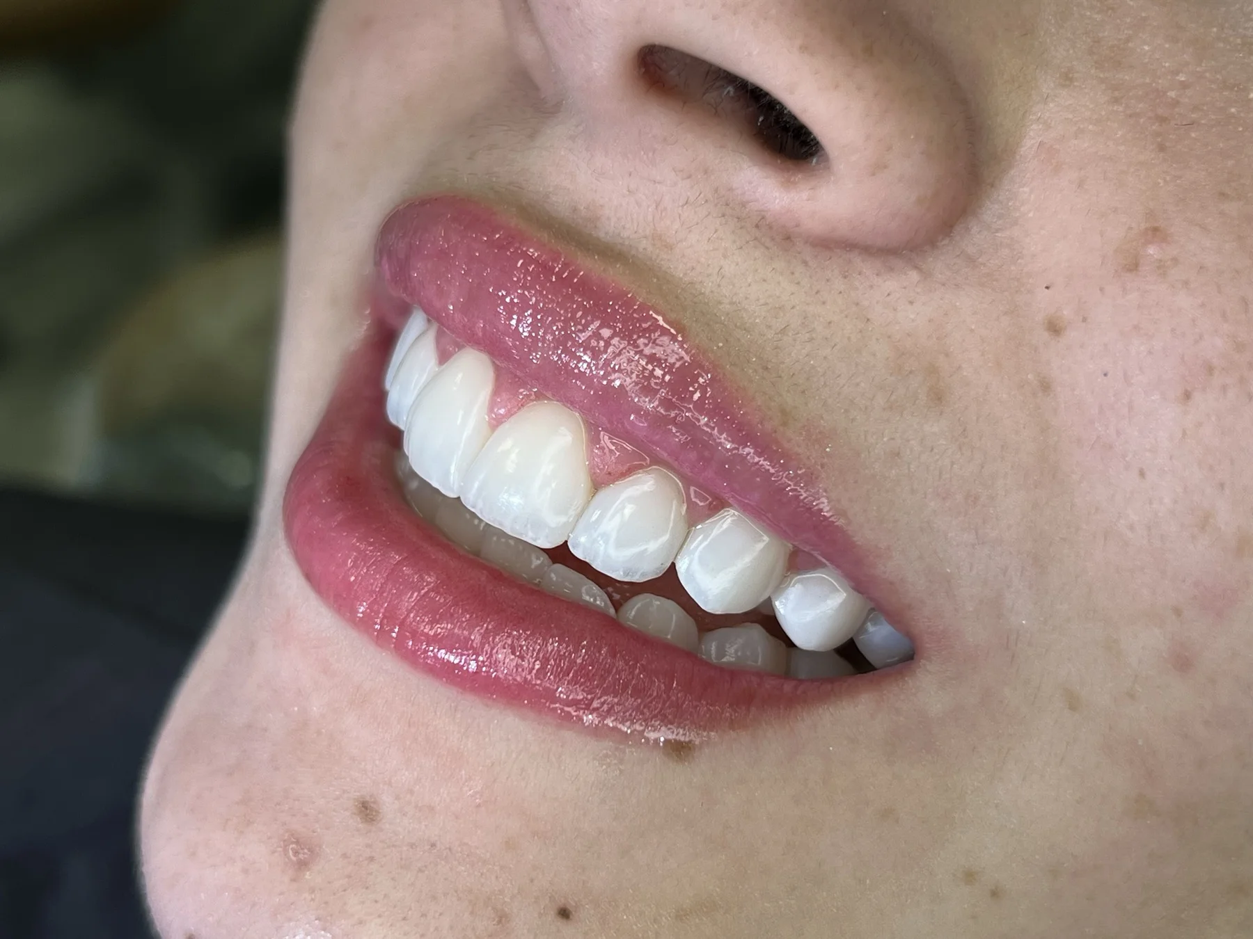 Resultado natural de facetas em resina em Curitiba