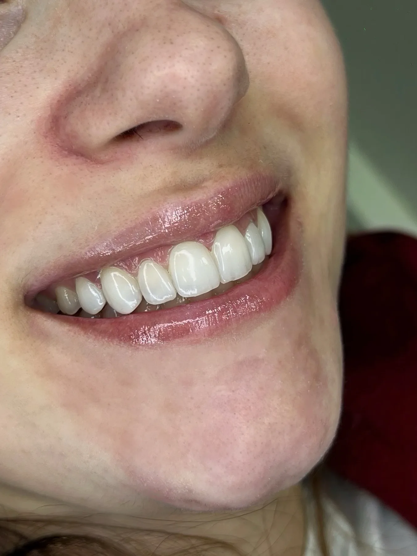 Resultado de facetas em resina com acabamento natural
