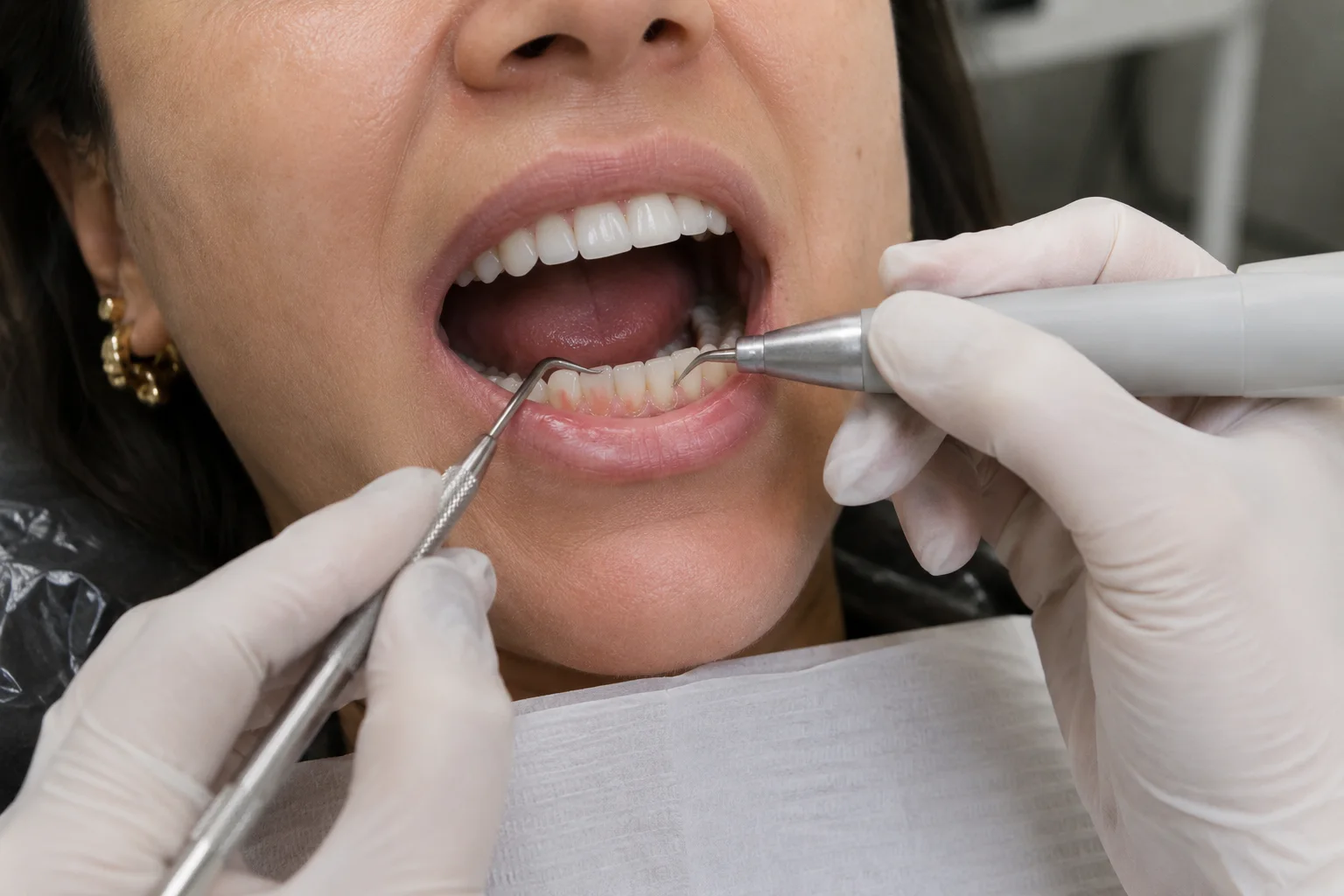 Procedimento de limpeza dental em Curitiba